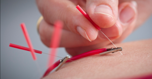 Medical Acupuncture